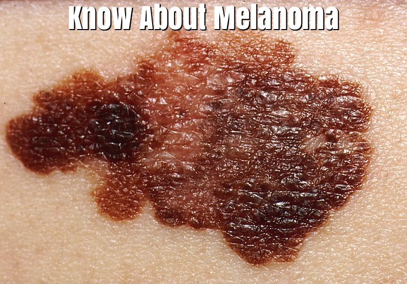 Melanoma Symptoms and Its treatments