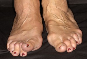 arthritis in feet