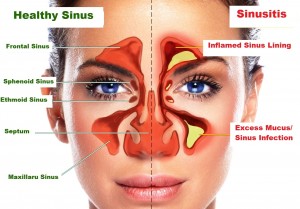 Sinusitis / Sinus Infection Symptoms - Home Remedies of Sinus