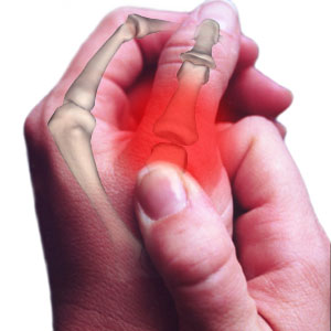 Arthritis in thumb