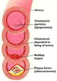 causes of high cholesterol