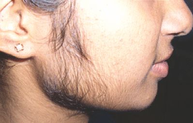 Steroid acne pics