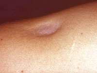 Skin atrophy steroids treatment