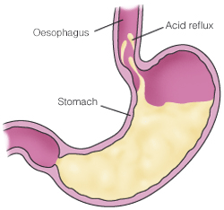 stomach acid