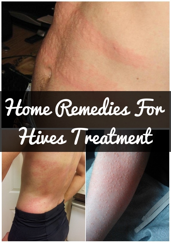 How To Get Rid Of Hives Naturally?