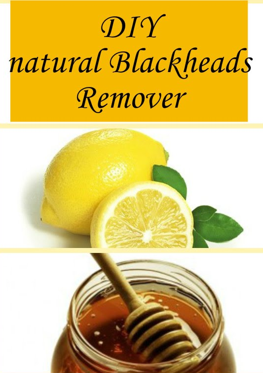 Home Remedies To Get Rid Of Blackheads
