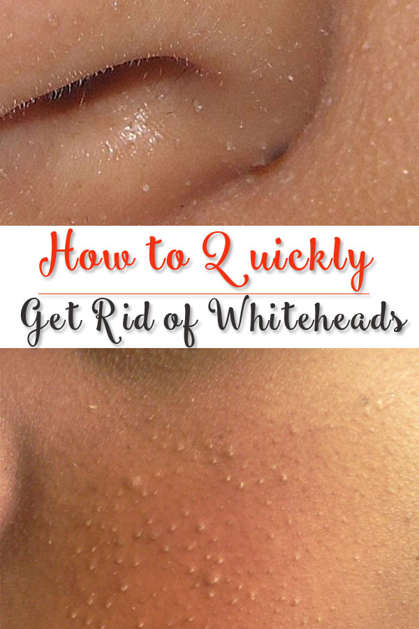 Home Remedies To Get Rid Of Whiteheads 