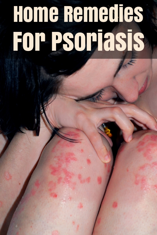 Natural Home Remedies For Psoriasis