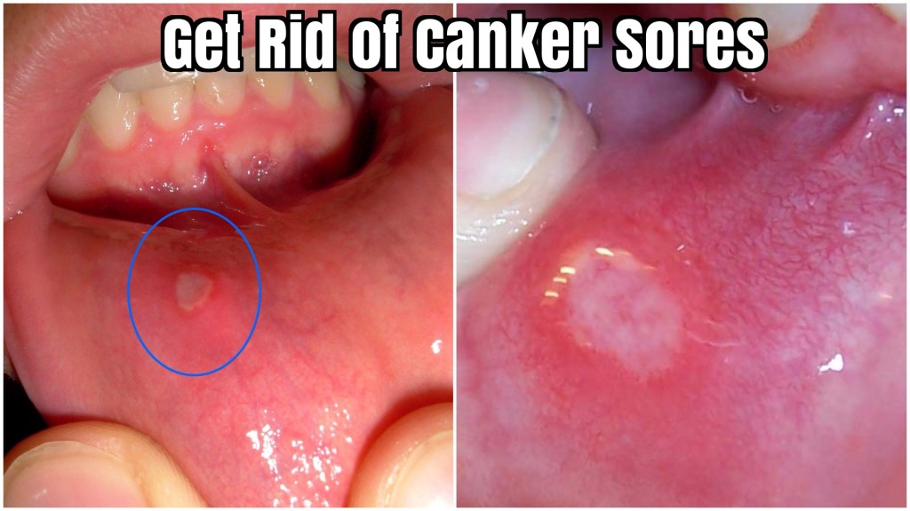 How to Get Rid of Canker Sores?