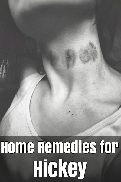 Home Remedies for Hickey
