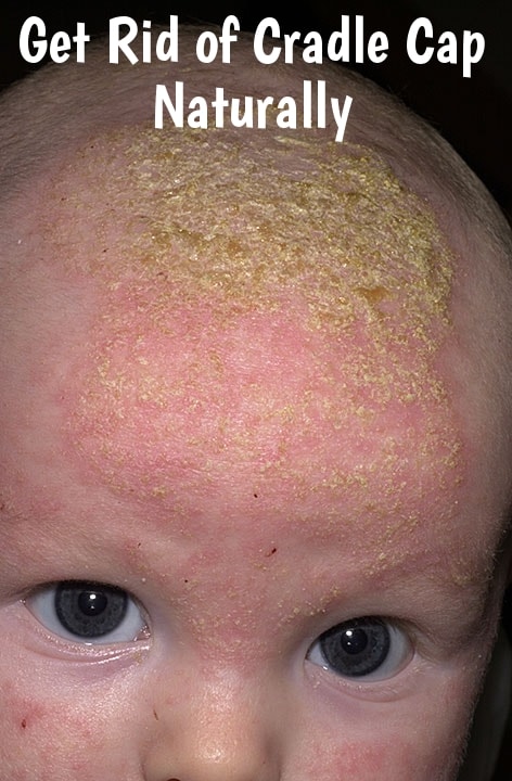 How To Get Rid of Cradle Cap Naturally?