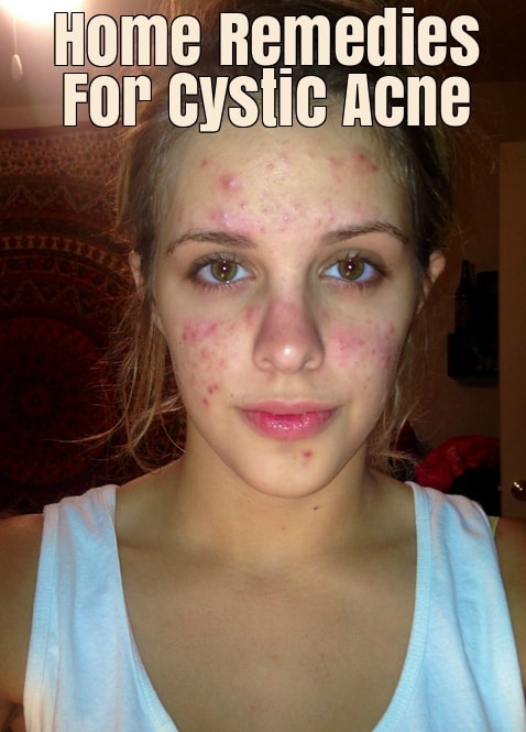 How To Get Rid of Cystic Acne?