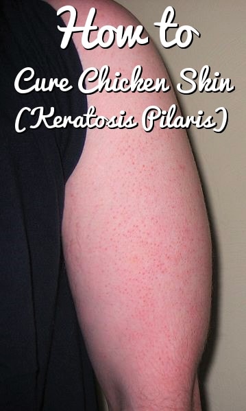 How to Get Rid of Keratosis Pilaris / Chicken Skin