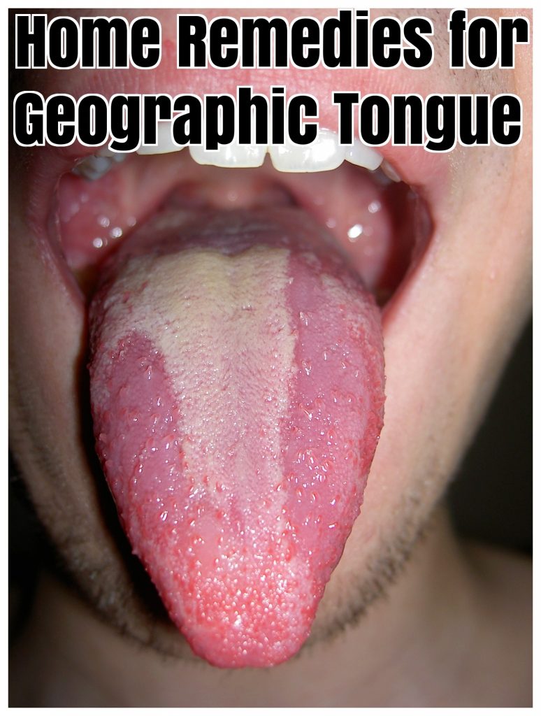 Home Remedies for Geographic Tongue