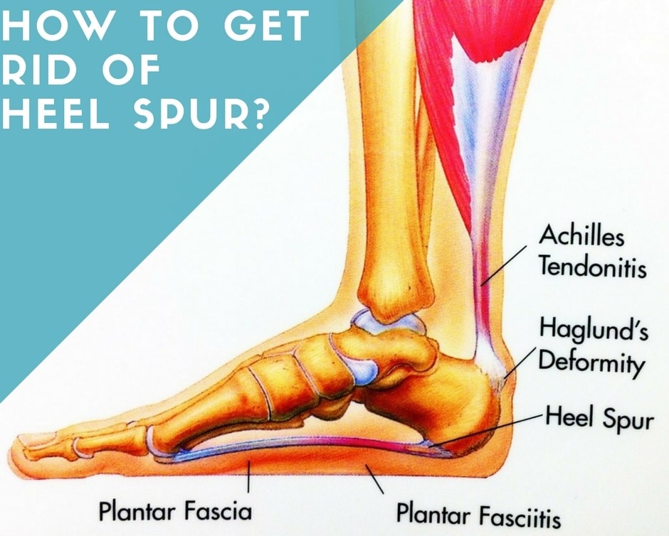 How To Get Rid of Heel Spur?
