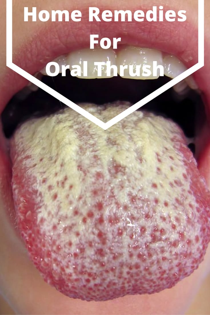 Top 12 Home Remedies For Oral Thrush - How To Get Rid Of -7321
