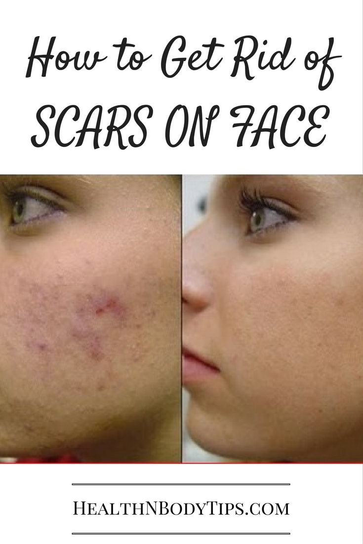 Of Rid Get To Scars Acne How
