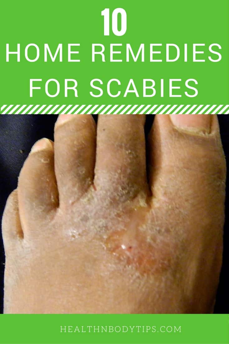 Natural Way To Get Rid Of Scabies 29